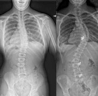 ماذا يجب أن يتجنبما العضو الأكثر تأثرًا باعوجاج العمود الفقري؟ما العضو الأكثر تأثرًا باعوجاج العمود الفقري؟