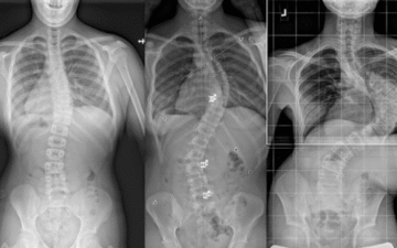 ماذا يحدث إذا لم يتم ارتداء حزام اعوجاج العمود الفقري؟