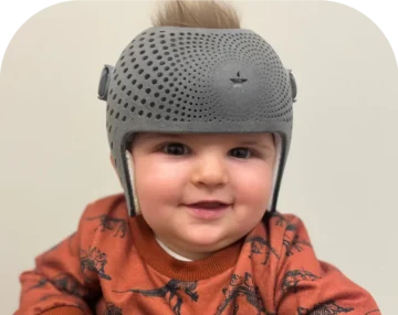 متى نحكم على نجاح خوذة علاج الرأس المسطح؟