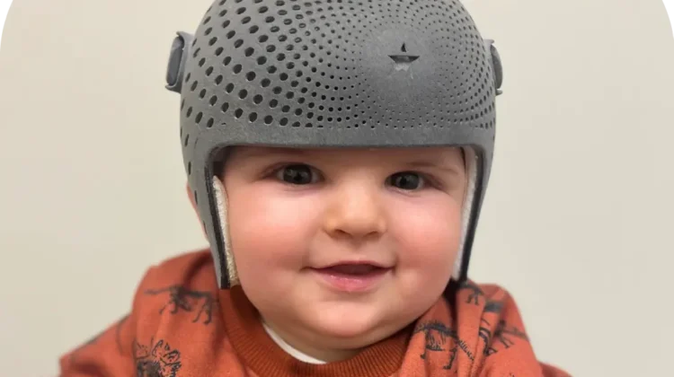 متى نحكم على نجاح خوذة علاج الرأس المسطح؟