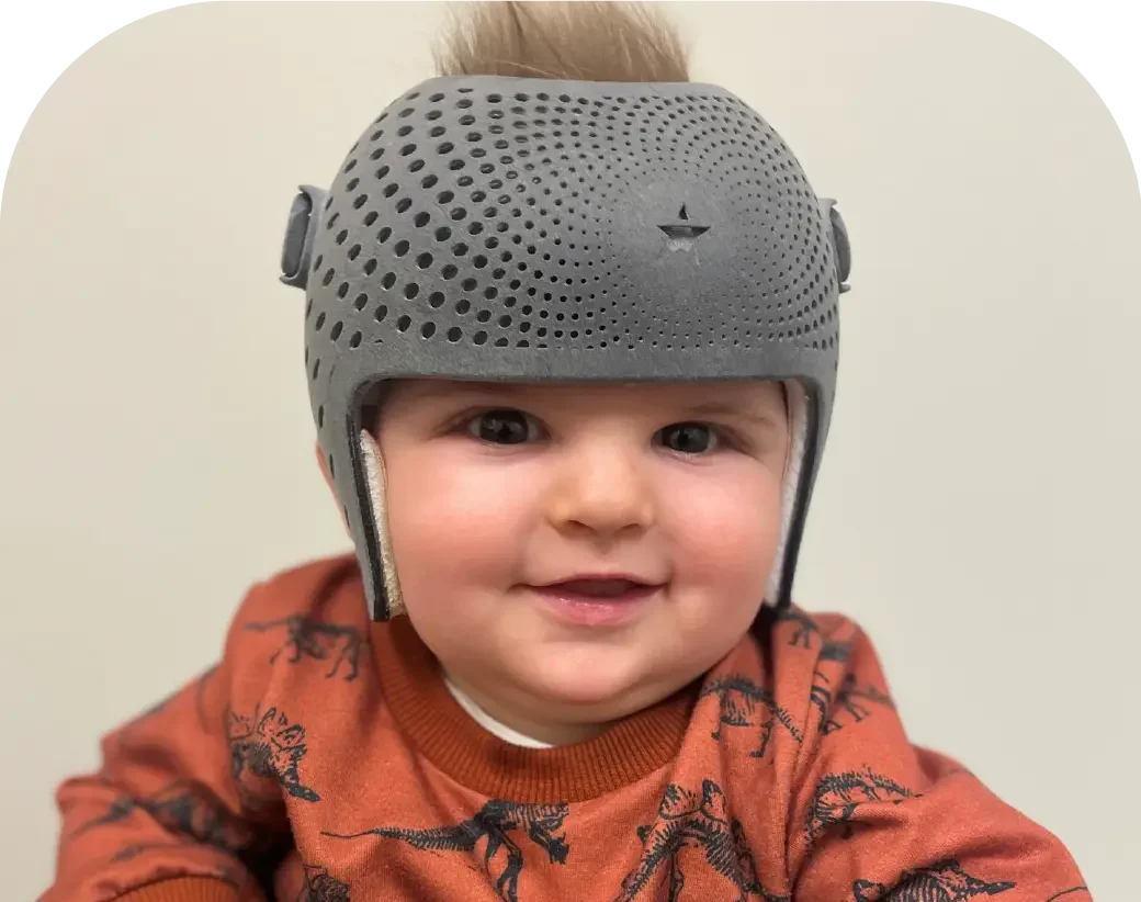 متى نحكم على نجاح خوذة علاج الرأس المسطح؟