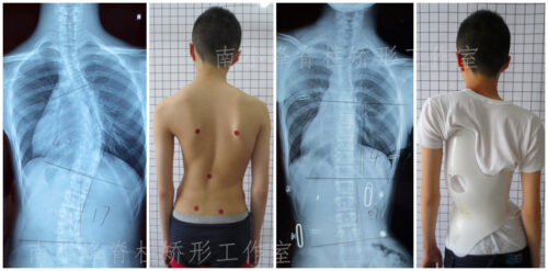 ما الذي يجب فعله وما يجب تجنبه عند الإصابة باعوجاج العمود الفقري