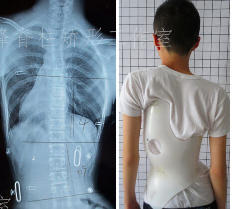 هل يحتاج الطفل لحزام اعوجاج العمود الفقري خلال منتصف النمو