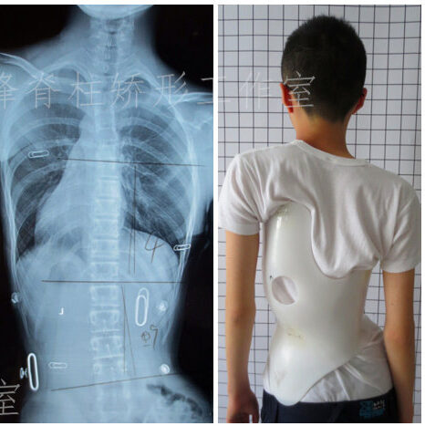هل يحتاج الطفل لحزام اعوجاج العمود الفقري خلال منتصف النمو