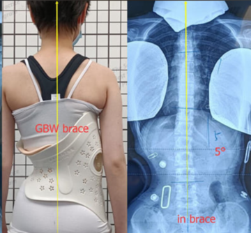 ما مدى شدة اعوجاج العمود الفقري التي تحتاج حزامًا؟