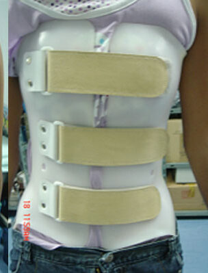 ما الحزام الذي يجب تجنبه عند علاج اعوجاج العمود الفقري؟