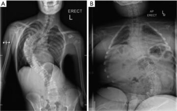 الأمراض العصبية التي تسبب اعوجاج العمود الفقري