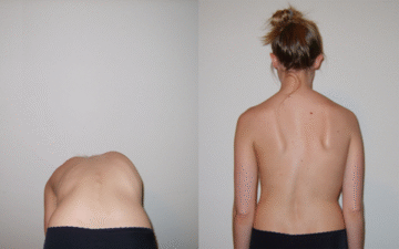 متى يبدأ اعوجاج العمود الفقري بالظهور؟ وكيف تمنع تطوره؟