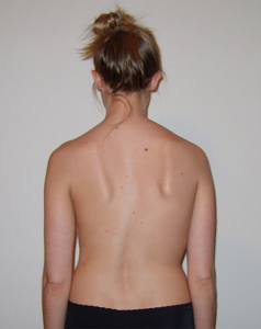 متى يبدأ اعوجاج العمود الفقري بالظهور؟ وكيف تمنع تطوره؟