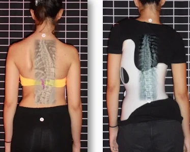 هل كل أحزمة اعوجاج العمود الفقري تحقق نفس النتائج؟ وكيف تختار الأفضل لطفلك