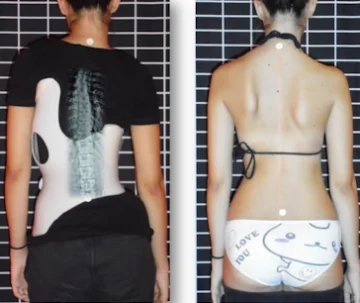 هل يمكن أن يضعف حزام اعوجاج العمود الفقري الظهر؟ حقائق علمية للأهل والمرضى