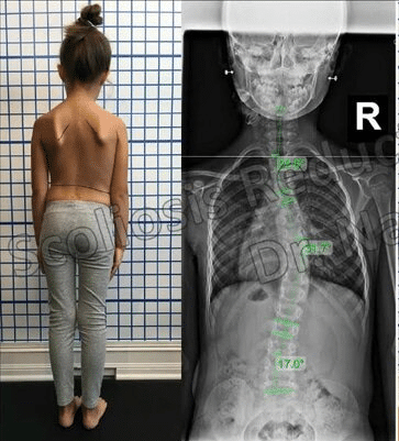في أي عمر يبدأ اعوجاج العمود الفقري عند الأطفال؟