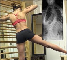 أنشطة قد تزيد من سوء اعوجاج العمود الفقري: ما هي وكيف تتجنبها؟