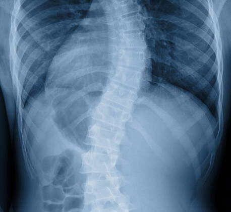 هل يؤثر اعوجاج العمود الفقري على شكل الوجه؟