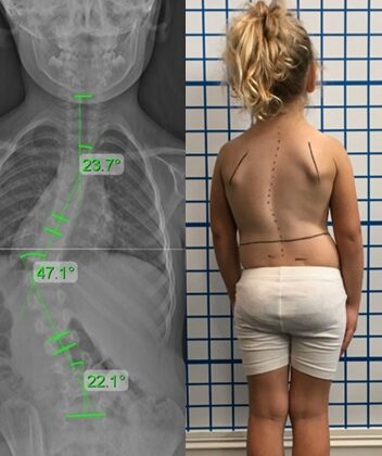 ماذا يحدث إذا تُرك اعوجاج العمود الفقري عند الأطفال دون علاج؟