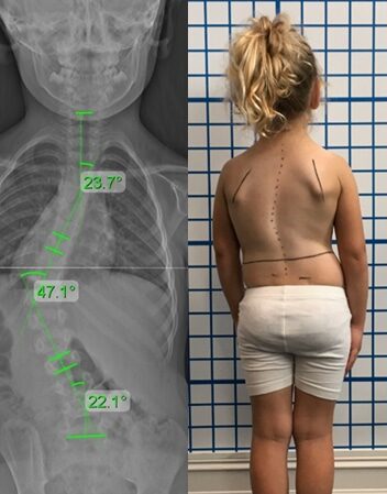ماذا يحدث إذا تُرك اعوجاج العمود الفقري عند الأطفال دون علاج؟