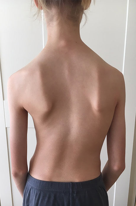 متى يمكن التوقف عن القلق بشأن اعوجاج العمود الفقري؟