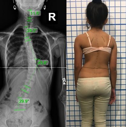 هل يزداد اعوجاج العمود الفقري عند الأطفال مع تقدم العمر؟