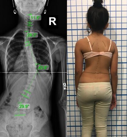 هل يزداد اعوجاج العمود الفقري عند الأطفال مع تقدم العمر؟