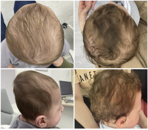 كيف تعمل خوذة علاج الرأس المسطح؟