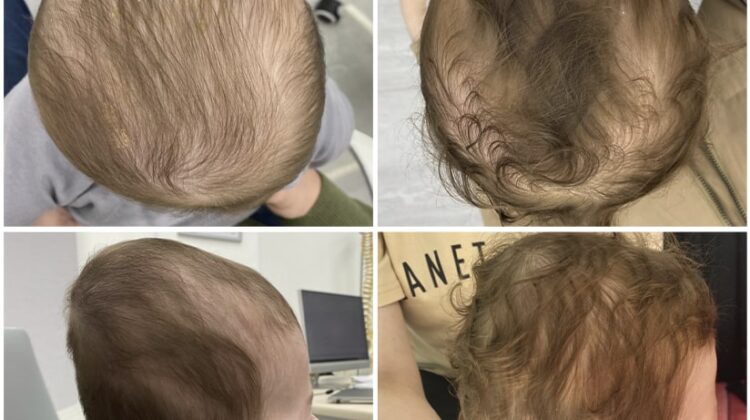 متى يصبح رأس الطفل المسطح خطرًا؟ علامات تحتاج لتدخل عاجل