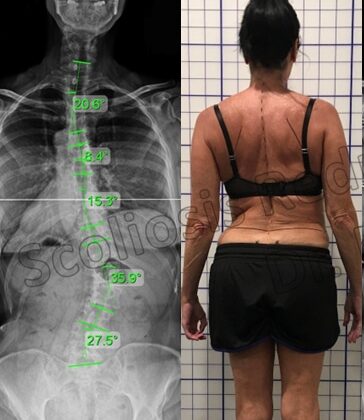 كيف يشعر مريض اعوجاج العمود الفقري؟