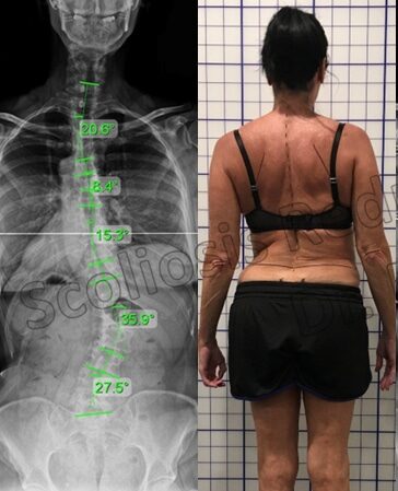 كيف يشعر مريض اعوجاج العمود الفقري؟