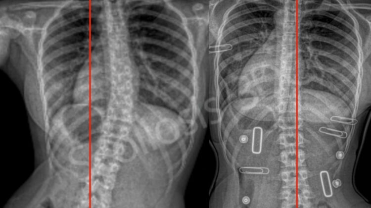المراحل الخمسة لحزام اعوجاج العمود الفقري: رحلة علاج طفلك خطوة بخطوة