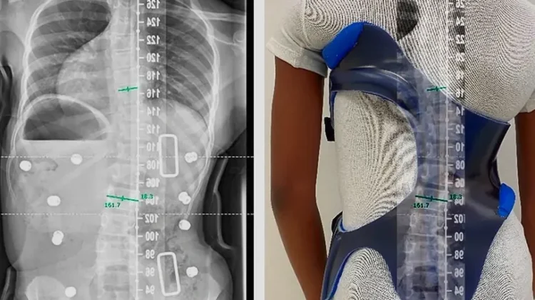 أهم العوامل التي تؤثر على التزام طفلك بحزام اعوجاج العمود الفقري