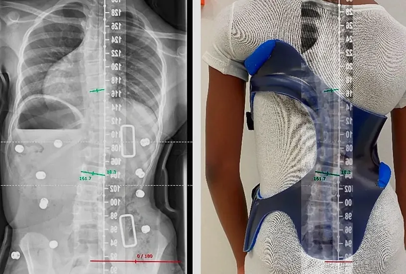 أهم العوامل التي تؤثر على التزام طفلك بحزام اعوجاج العمود الفقري