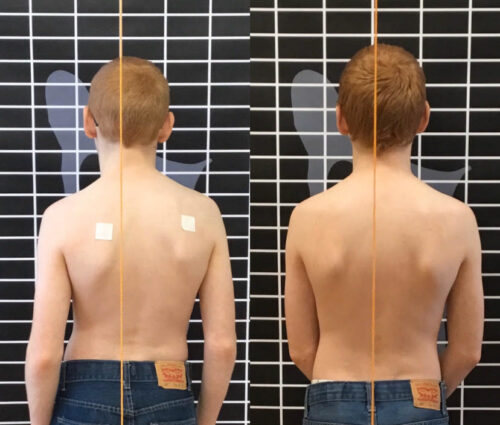 يُعد برنامج شروث (Schroth Method) تمارين علاجية مخصصة لاعوجاج العمود الفقري