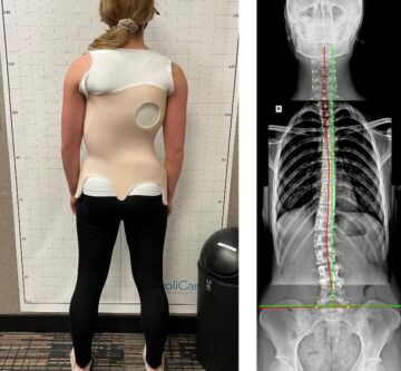 كم تستغرق مدة العلاج بحزام اعوجاج العمود الفقري؟