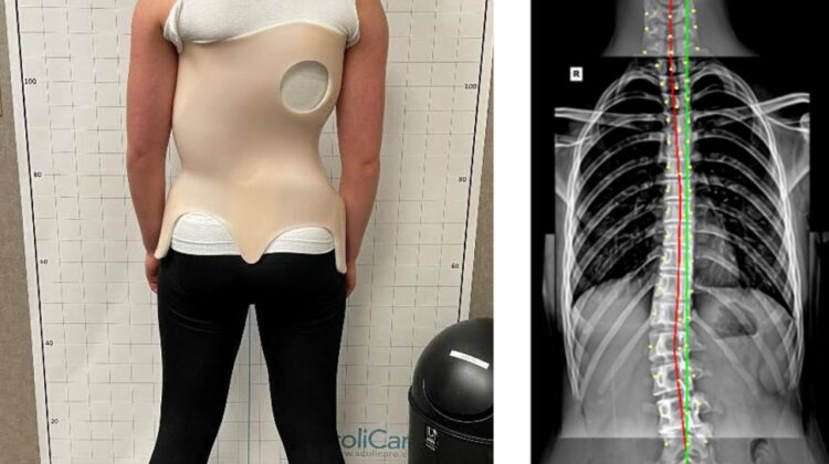 كم تستغرق مدة العلاج بحزام اعوجاج العمود الفقري؟