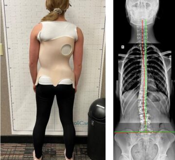كم عدد المرضى اللازم علاجهم بحزام اعوجاج العمود الفقري لمنع جراحة واحدة؟