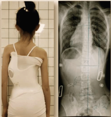 كيف تعرف أن حزام اعوجاج العمود الفقري يعمل؟ 5 علامات حقيقية للنجاح