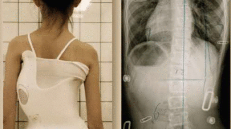 كيف تعرف أن حزام اعوجاج العمود الفقري يعمل؟ 5 علامات حقيقية للنجاح