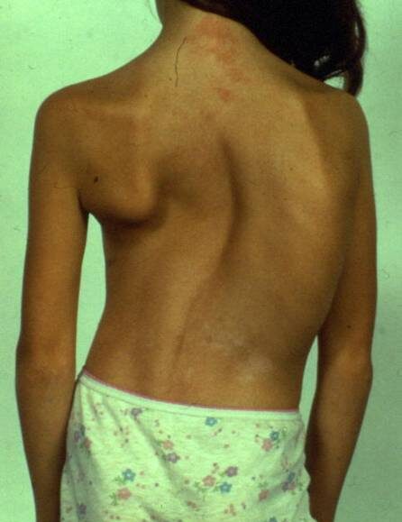 المرحلة الأخيرة من اعوجاج العمود الفقري: الأعراض والمضاعفات وخيارات العلاج