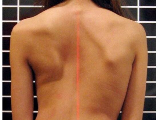 علامات اعوجاج العمودما الفرق بين اعوجاج العمود الفقري عند الأولاد والبنات؟ دليل مبسط للأهل