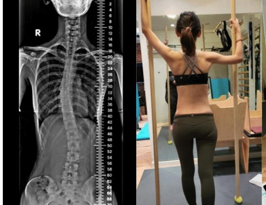 ما هو أفضل علاج طبيعي لاعوجاج العمود الفقري؟ دليل كامل للأهل