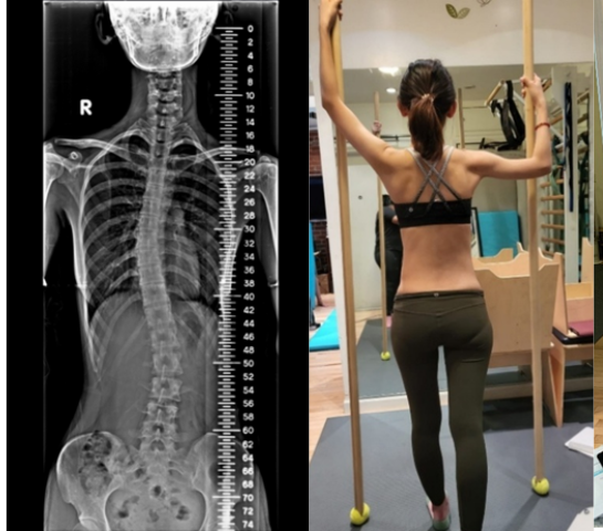 ما هو أفضل علاج طبيعي لاعوجاج العمود الفقري؟ دليل كامل للأهل