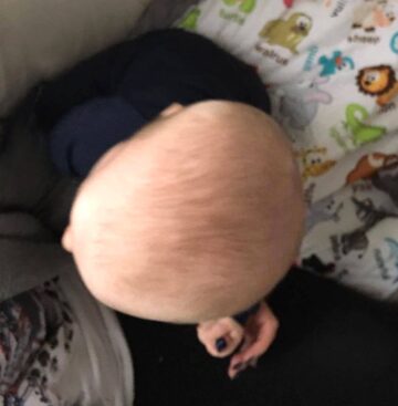 كيف تتوقع تطور الرأس المسطح عند الأطفال بدقة؟ وتتجنب المضاعفات