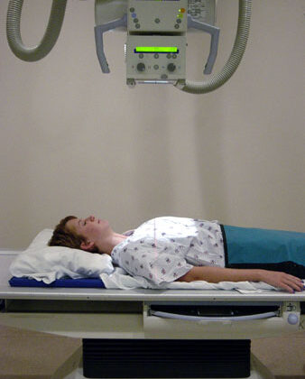 كيف تتوقع بدقة نتائج حزام اعوجاج العمود الفقري