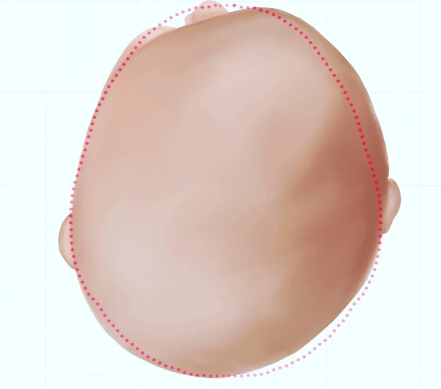 هل يمكن أن يسبب تسطّح الرأس عند الأطفال بروزًا في الجبهة؟