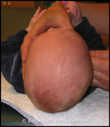 العوامل التي تتنبأ بشدة تشوه الرأس المسطح عند الرضع