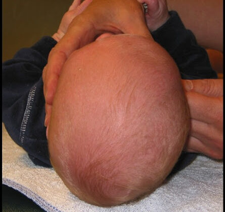 العوامل التي تتنبأ بشدة تشوه الرأس المسطح عند الرضع