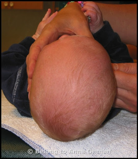 العوامل التي تتنبأ بشدة تشوه الرأس المسطح عند الرضع