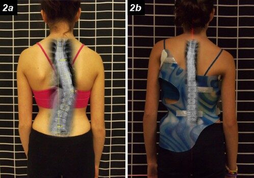 فعالية حزام اعوجاج العمود الفقري: كيف يقلل الأنحناء ويحقق نتائج ملموسة