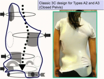 حزام اعوجاج العمود الفقري للأطفال: كيف يؤثر مكان وسادة الضغط على نجاح العلا