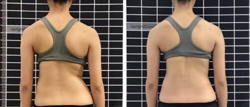 متى يكون العلاج الطبيعي مفيدًا عادة في علاج اعوجاج العمود الفقري؟