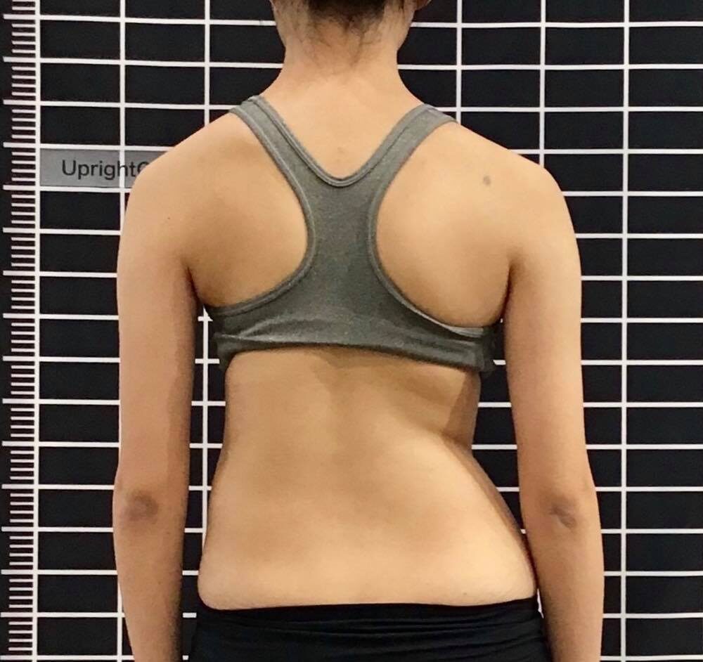 هل يمكنني أن أعيش حياة طبيعية مع وجود اعوجاج العمود الفقري؟